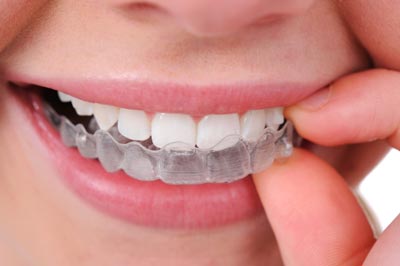 Invisible Brace in Karve Nagar Pune Invisible Brace in Karve Nagar Pune