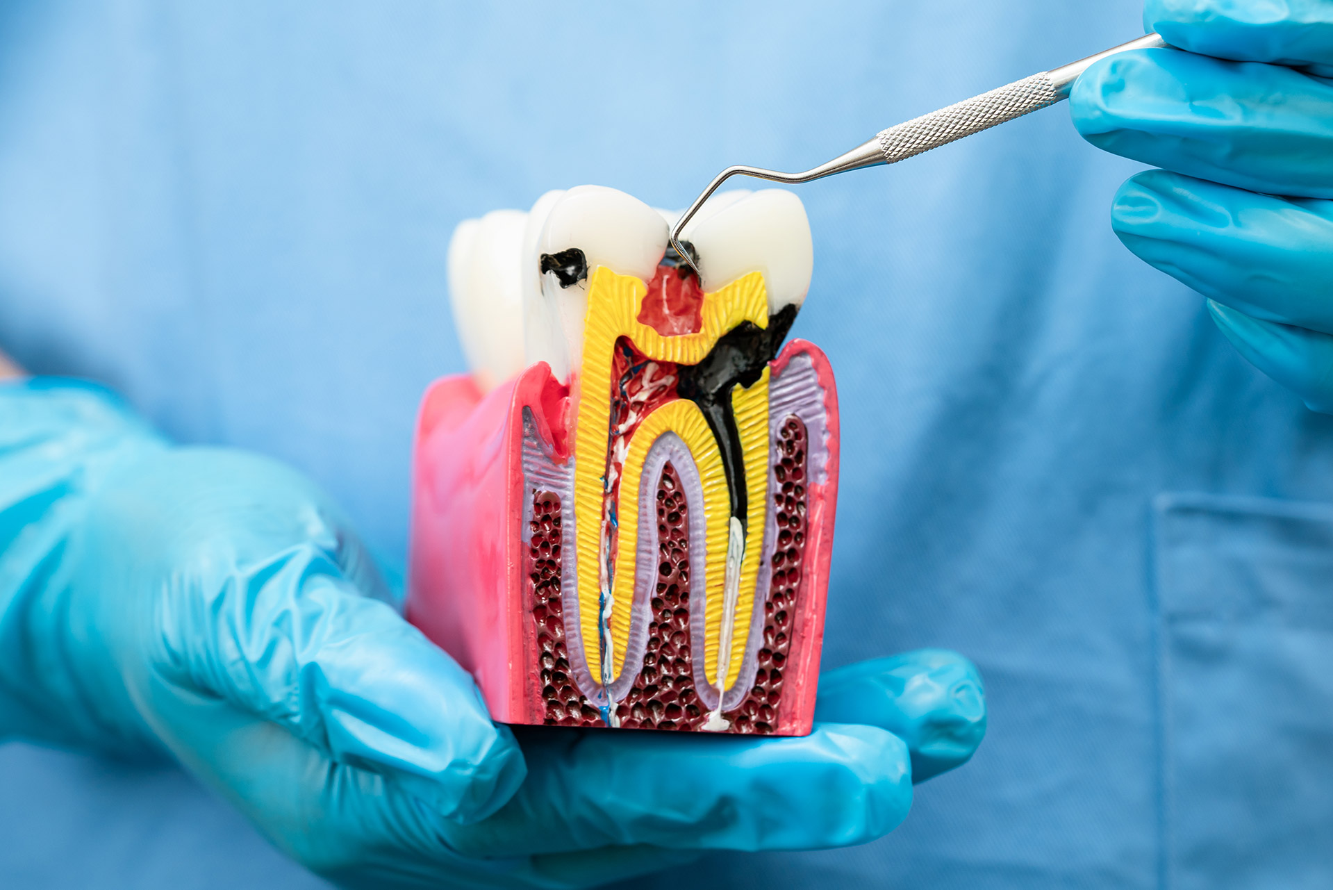 Root Canal Treatments in Karve Nagar Root Canal Treatments in Karve Nagar