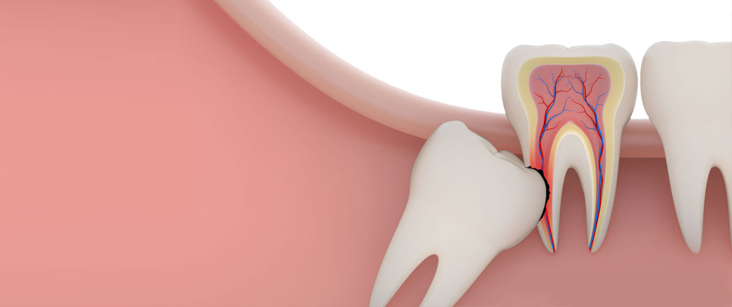 Wisdom Tooth Extraction Karve Nagar Wisdom Tooth Extraction Karve Nagar