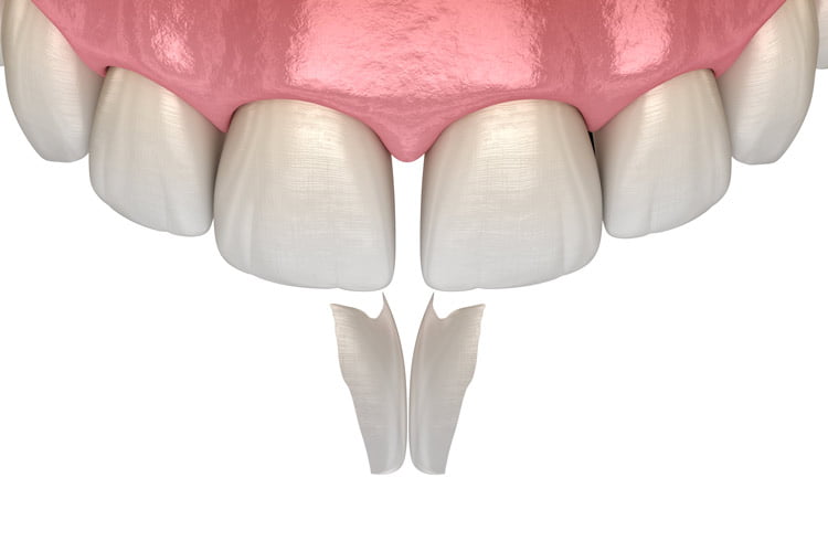 Dental Bonding Treatment Karve Nagar Dental Bonding Treatment Karve Nagar