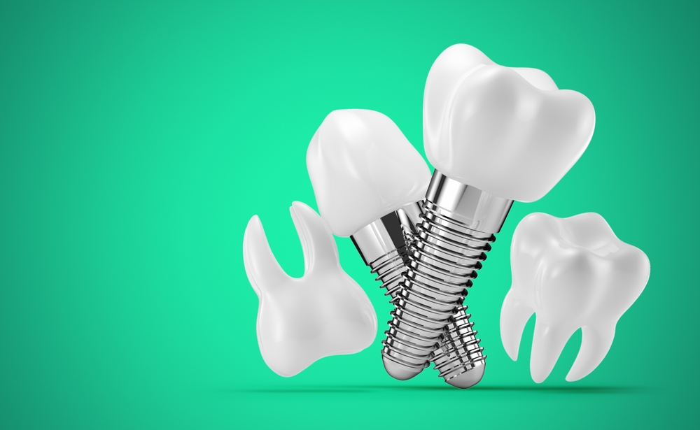 Dental Implants Treatment Karve Nagar Dental Implants Treatment Karve Nagar