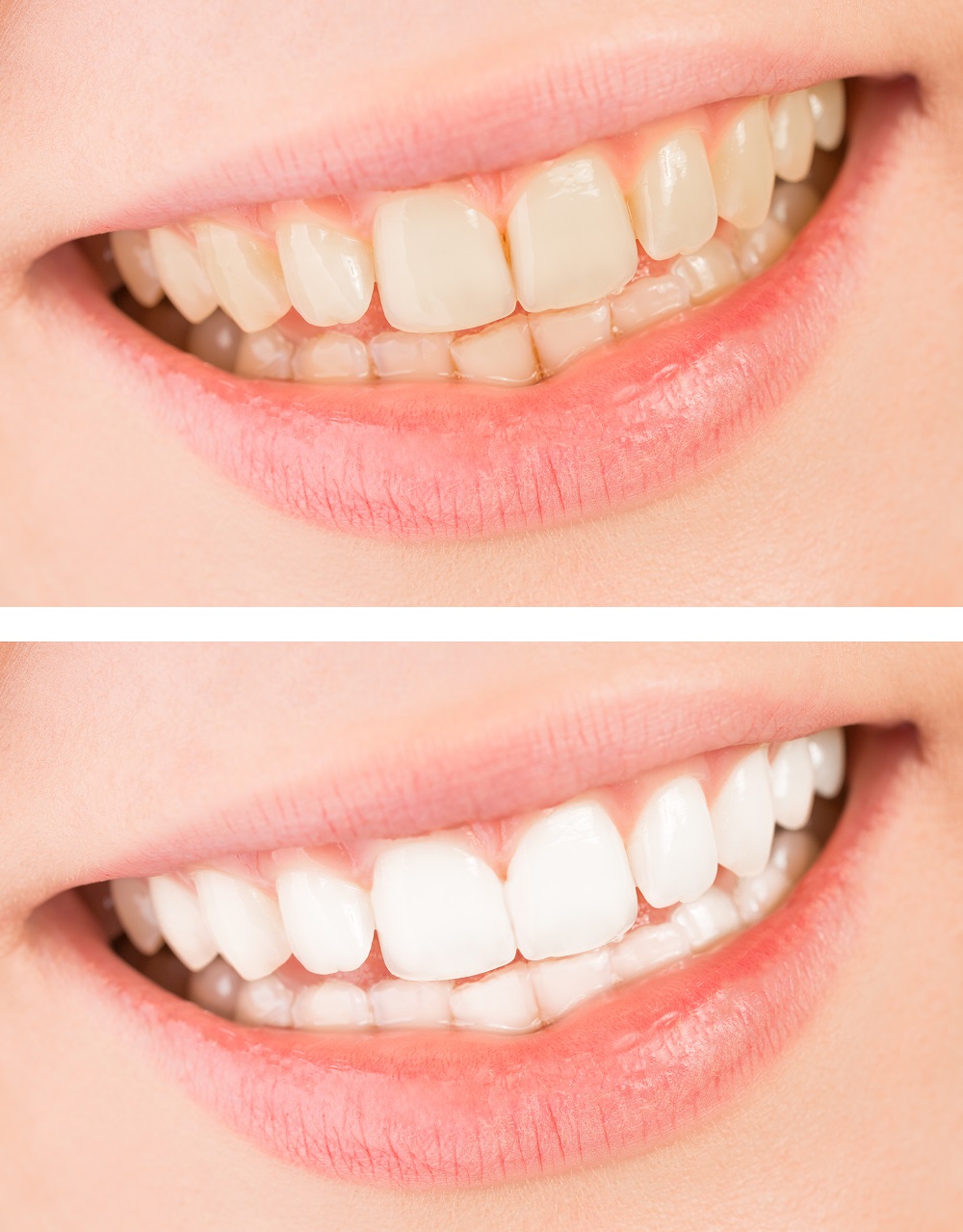 Teeth Whitening Treatment Karve Nagar Teeth Whitening Treatment Karve Nagar